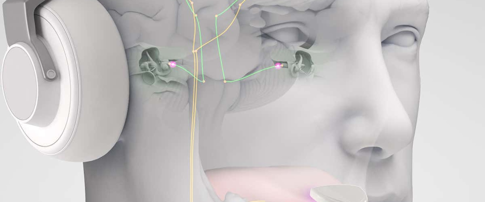 What are the 4 types of tinnitus?
